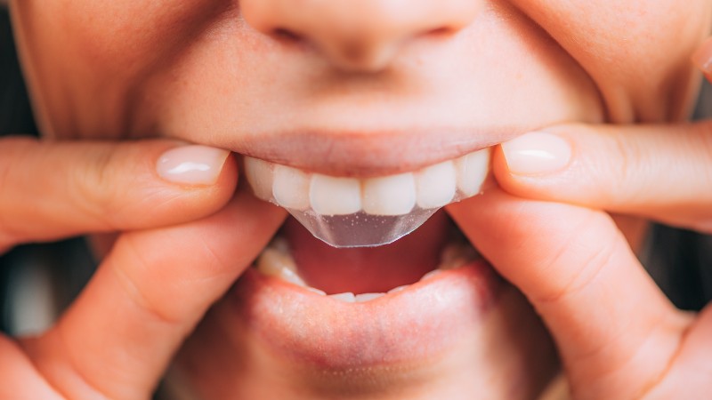 Cuidados posteriores a un blanqueamiento dental: Consejos prácticos